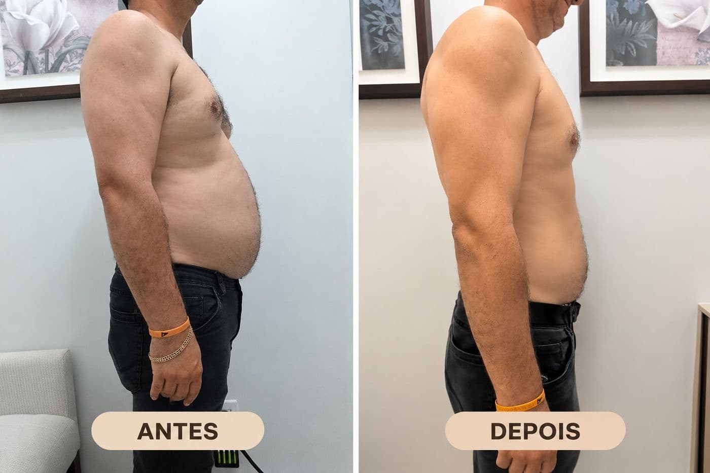 Evolução de paciente acompanhado pelo Dr. Paullineli: antes e depois
